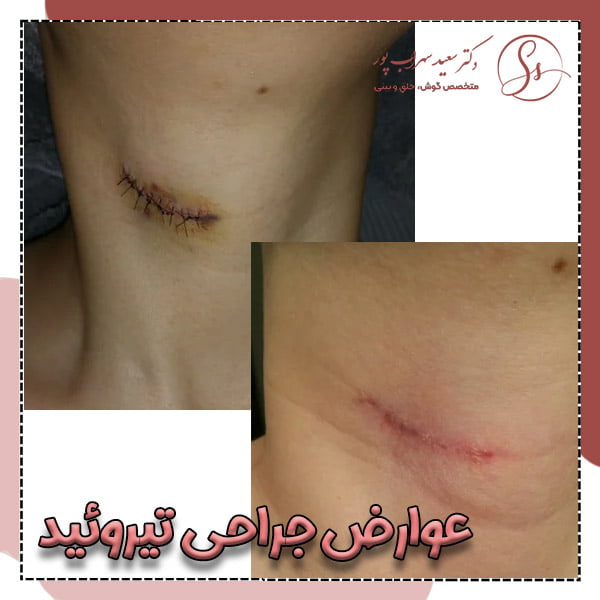 عوارض جراحی تیروئید - دکتر سهراب پور