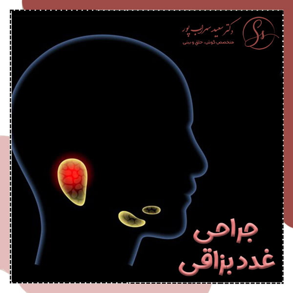 جراحی غدد بزاقی - دکتر سعید سهراب پور
