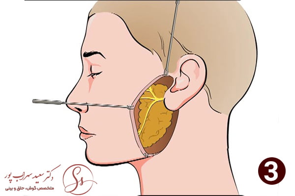 مرحله سوم جراحی غدد بزاقی