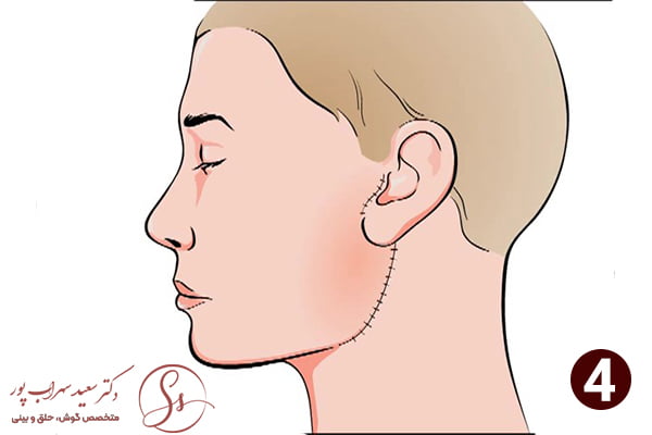 مرحله چهارم جراحی غدد بزاقی